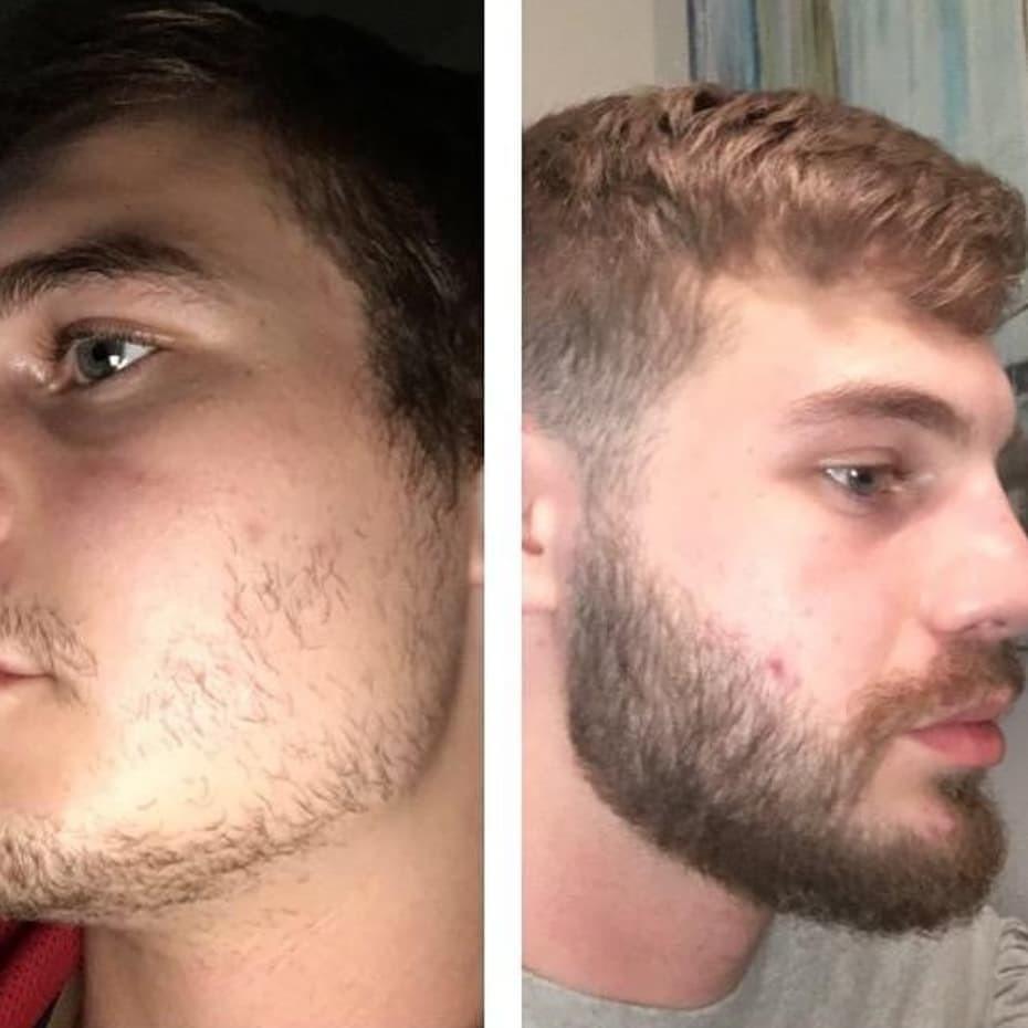 Kit 3x Minoxidil + 3x Multivitamínico Ativador MAJOR – Barba e Cabelo 3 Kit 3x Minoxidil + 3x Multivitamínico Ativador MAJOR – Barba e Cabelo - Imagem 3