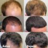 Kit 3x Minoxidil + 3x Multivitamínico Ativador MAJOR – Barba e Cabelo 7 BTV - Site Oficial Tratamento eficaz contra falhas no cabelo com Minoxidil vitaminas