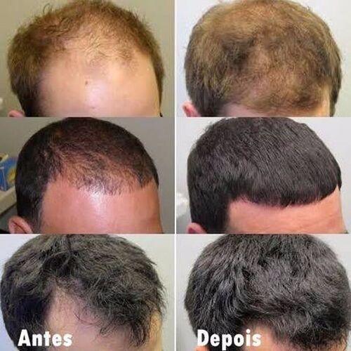 Kit 3x Minoxidil + 3x Multivitamínico Ativador MAJOR – Barba e Cabelo 4 Kit 3x Minoxidil + 3x Multivitamínico Ativador MAJOR – Barba e Cabelo - Imagem 4